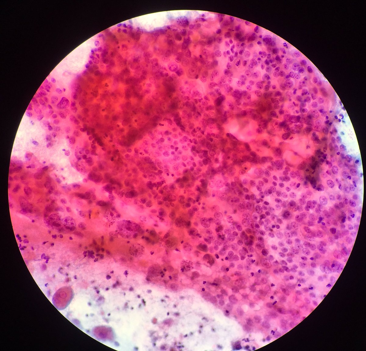 TCytologist's tweet photo. Case on working today.Female 57yrs. Menopause 2 yrs,and post menopause bleeding. Conventional  pap smear,.Pap stained.💉💉 🔬🔬🦠🦠 #cytology  #papstain #cytopatho #cytopath  #cytotechnologist #cytologists https://t.co/v6Jk7lLUIs