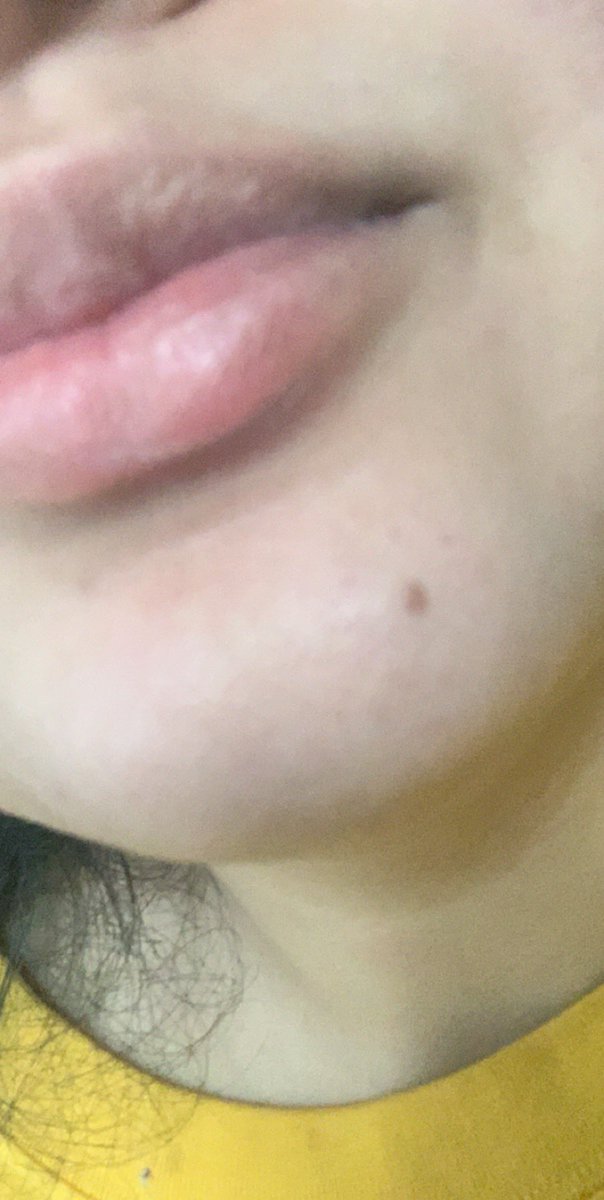 melanie18f's tweet photo. @almanza_rafa It’s already getting bad af, it still hasn’t gotten swollen 😭😭 https://t.co/1aRBxEYe5P
