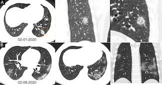 Le scanner, nouvel étalon pour le dépistage précoce du #coronavirus  <a href="/radiology_rsna/">Radiology</a> #COVIDー19 <a href="/SFRadiologie/">SFR (Radiologie)</a> <a href="/Fnmr_radiologue/">Fédération Nationale des Médecins Radiologues</a> #scanner #polymerase thema-radiologie.fr/actualites/260…