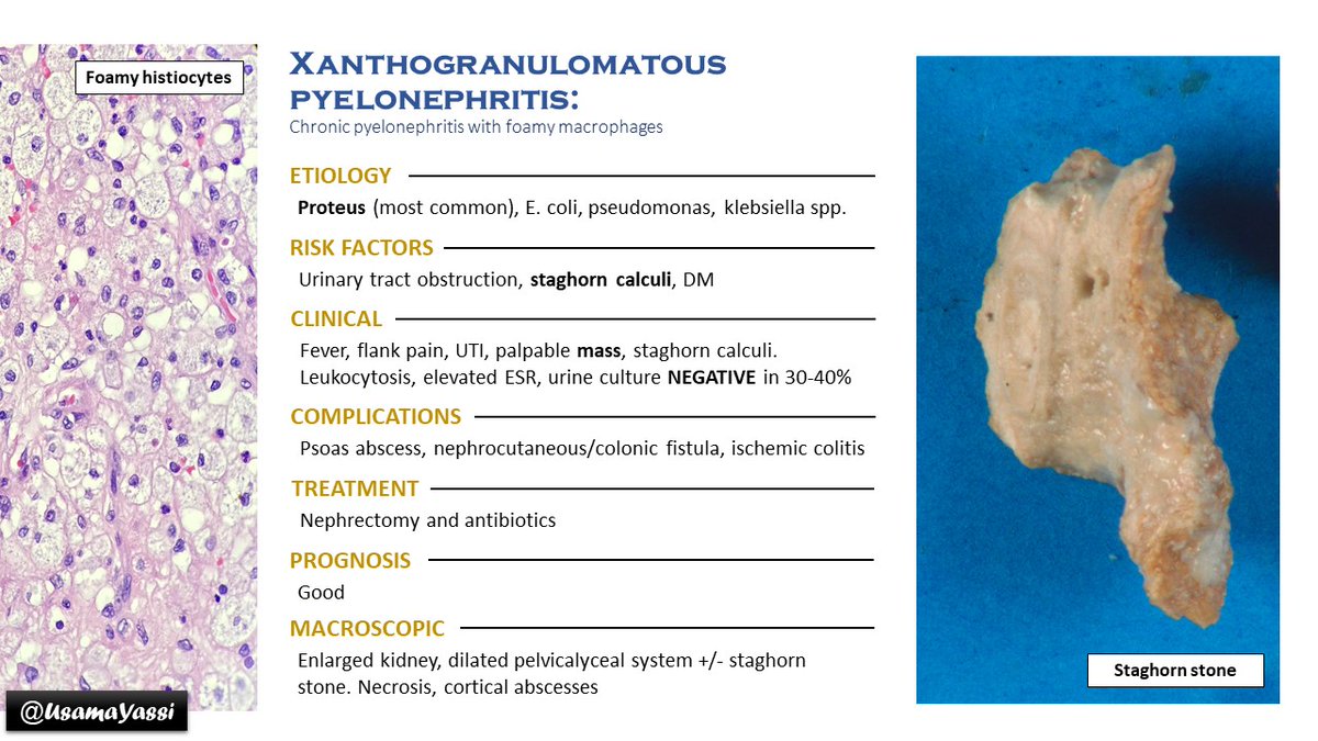 It's been a while, here is a flashcard about xanthogranulomatous pyelonephritis that can be a pitfall for RCC. If in doubt, IHC helps (CD68 highlights histiocytes vs cytokeratin will highlight RCC). #Pathologyflashcards #GUpath