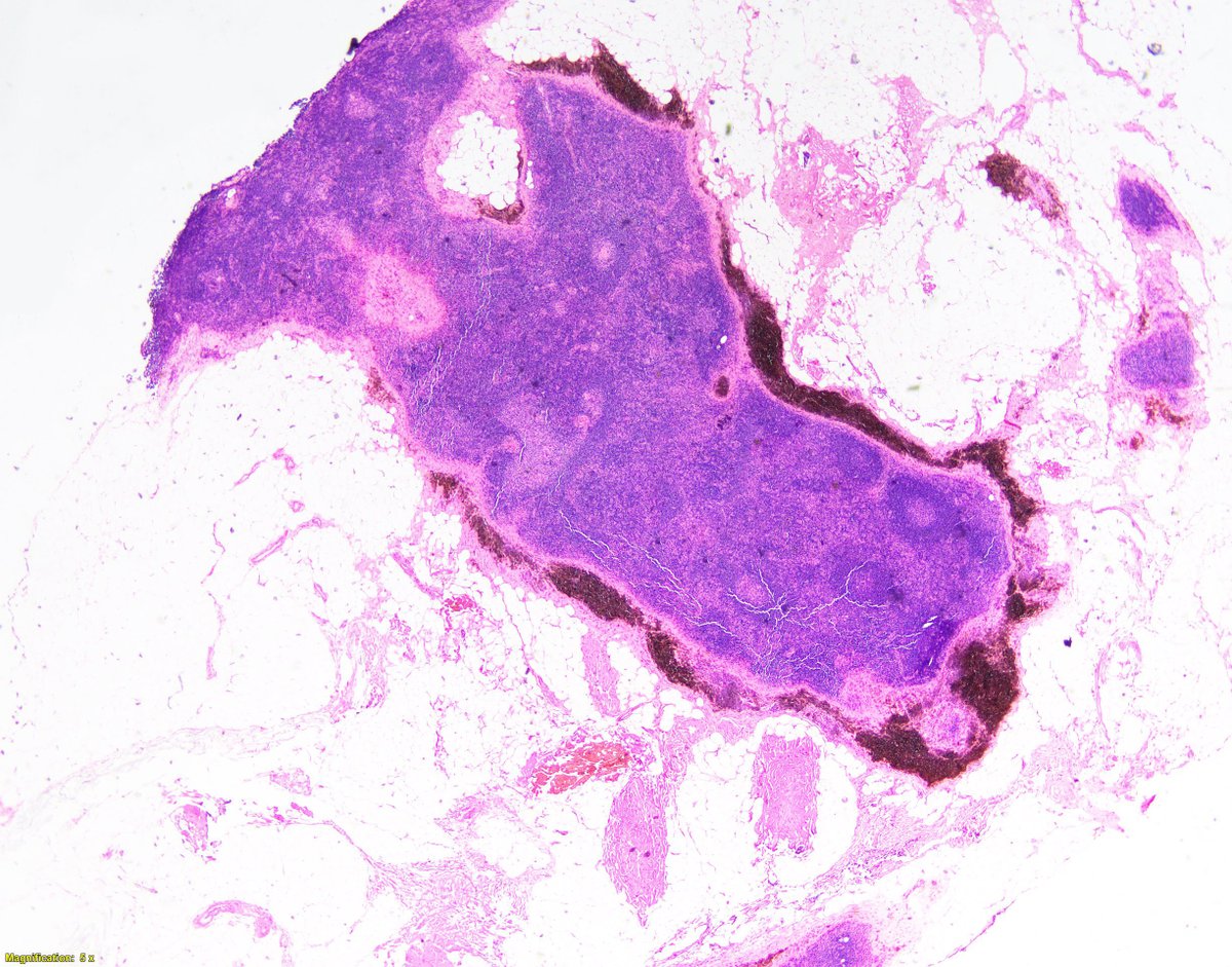 PatMcIntireMD's tweet photo. Axillary lymph node: The very rare - "Nodal Blue Nevus"

AKA-not melanoma

https://t.co/hRTPBeYkJu https://t.co/gaXyBNnsn3
