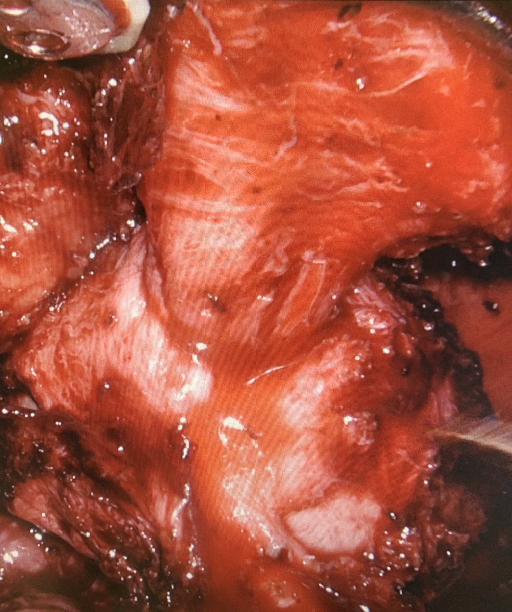 Yannic Raskin (@yraskin) on Twitter photo First radical prostatectomy with the Bocciardi technique <a href="/UZLeuven/">UZ Leuven</a> with <a href="/joniau/">steven joniau</a> and @yvesderuyver within the #ARNEOtrial <a href="/devos_gaetan/">Gaëtan Devos</a>. Pretty nice bladder neck! Let's see what happens at catheter removal.. First radical prostatectomy with the Bocciardi technique <a href="/UZLeuven/">UZ Leuven</a> with <a href="/joniau/">steven joniau</a> and @yvesderuyver within the #ARNEOtrial <a href="/devos_gaetan/">Gaëtan Devos</a>. Pretty nice bladder neck! Let's see what happens at catheter removal..