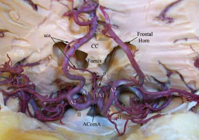 DrBaskaya's tweet photo. #AComA perforators: chiasmatic, hypothalamic & subcallosal
The #subcallosal artery (sca) is a single branch & the largest
https://t.co/DQPpWrcc7B
#microsurgery #residency #medicaleducation #uwhealth #neurosurgeon #Neuroanatomy #research #neurosurgery #nsgy #skullbase #aneurysm https://t.co/vs4su30lSs