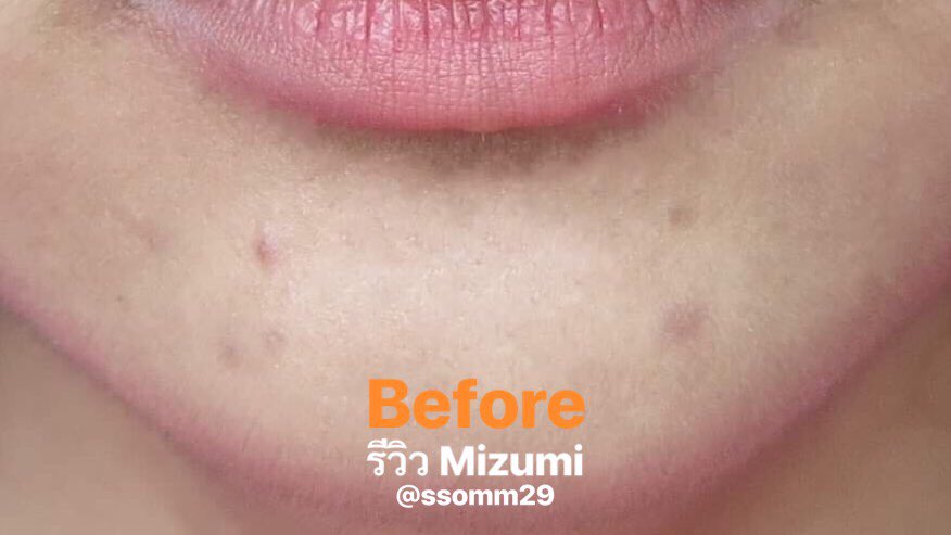ssompchp's tweet photo. ช่วงนี้ใส่หน้ากากอนามัยทุกวัน สิวขึ้นคางเยอะมากๆ เป็นๆหายๆ แล้วทิ้งรอยไว้ เราใช้ Mizumi ซองฟ้าแต้มสิว ซองเขียวลดรอยสิว ในรูปคือระยะเวลาประมาณ 14 วันที่ใช้เจ้าซองเขียวนะคะ ตกใจผลเหมือนกัน😱 จะเห็นว่าเหลือแต่รอยดำใหญ่ๆ แต่เล็กๆหายไปเยอะเลยค่ะ (1)
#รีวิวเซเว่น #HowtoPerfect https://t.co/BP9VAeaK7k