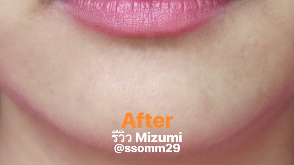 ssompchp's tweet photo. ช่วงนี้ใส่หน้ากากอนามัยทุกวัน สิวขึ้นคางเยอะมากๆ เป็นๆหายๆ แล้วทิ้งรอยไว้ เราใช้ Mizumi ซองฟ้าแต้มสิว ซองเขียวลดรอยสิว ในรูปคือระยะเวลาประมาณ 14 วันที่ใช้เจ้าซองเขียวนะคะ ตกใจผลเหมือนกัน😱 จะเห็นว่าเหลือแต่รอยดำใหญ่ๆ แต่เล็กๆหายไปเยอะเลยค่ะ (1)
#รีวิวเซเว่น #HowtoPerfect https://t.co/BP9VAeaK7k