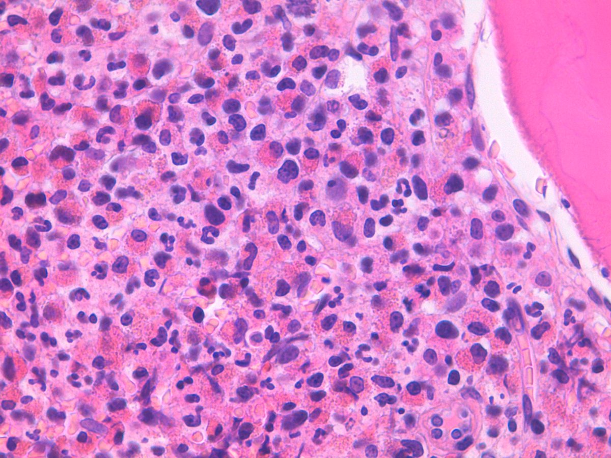 Is eosinophil dysplasia objective?
Adult male, unexplained hyperesosinophilia; no clonal abnormality (neg. BCR/ABL, JAK2, FGFR1, PDGFRA/B, ...); but these eosinophils are really ugly 😱
Q: Can chronic eosinophilic leukemia be diagnosed only on the basis of cytology / histology?