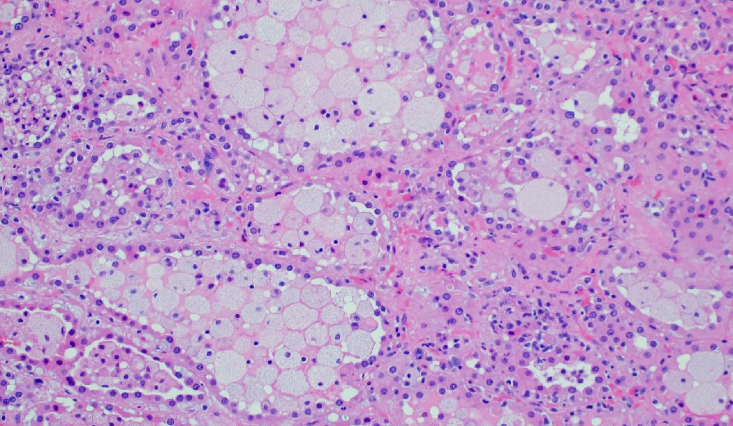 mhassanaimc's tweet photo. 63/M with renal mass 8.5 cm @DrGeeONE
 
@OBGYNPATH
 
@Dramanyhassany1 https://t.co/sVrXytMfSi