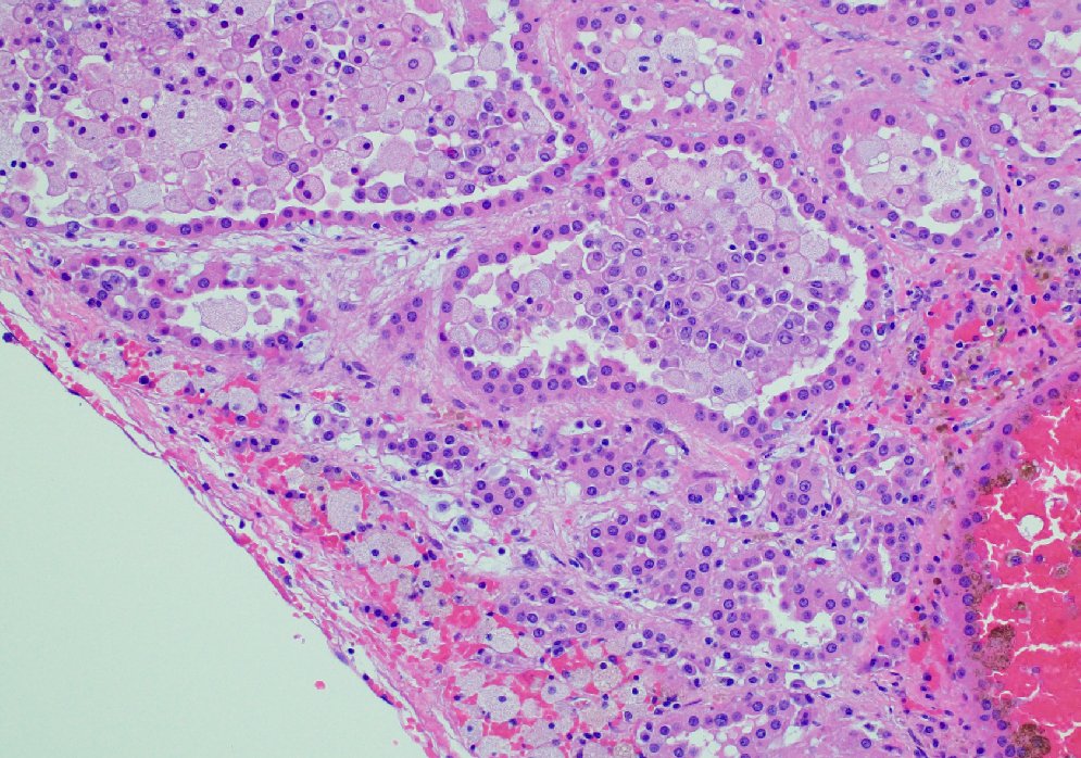 mhassanaimc's tweet photo. 63/M with renal mass 8.5 cm @DrGeeONE
 
@OBGYNPATH
 
@Dramanyhassany1 https://t.co/sVrXytMfSi