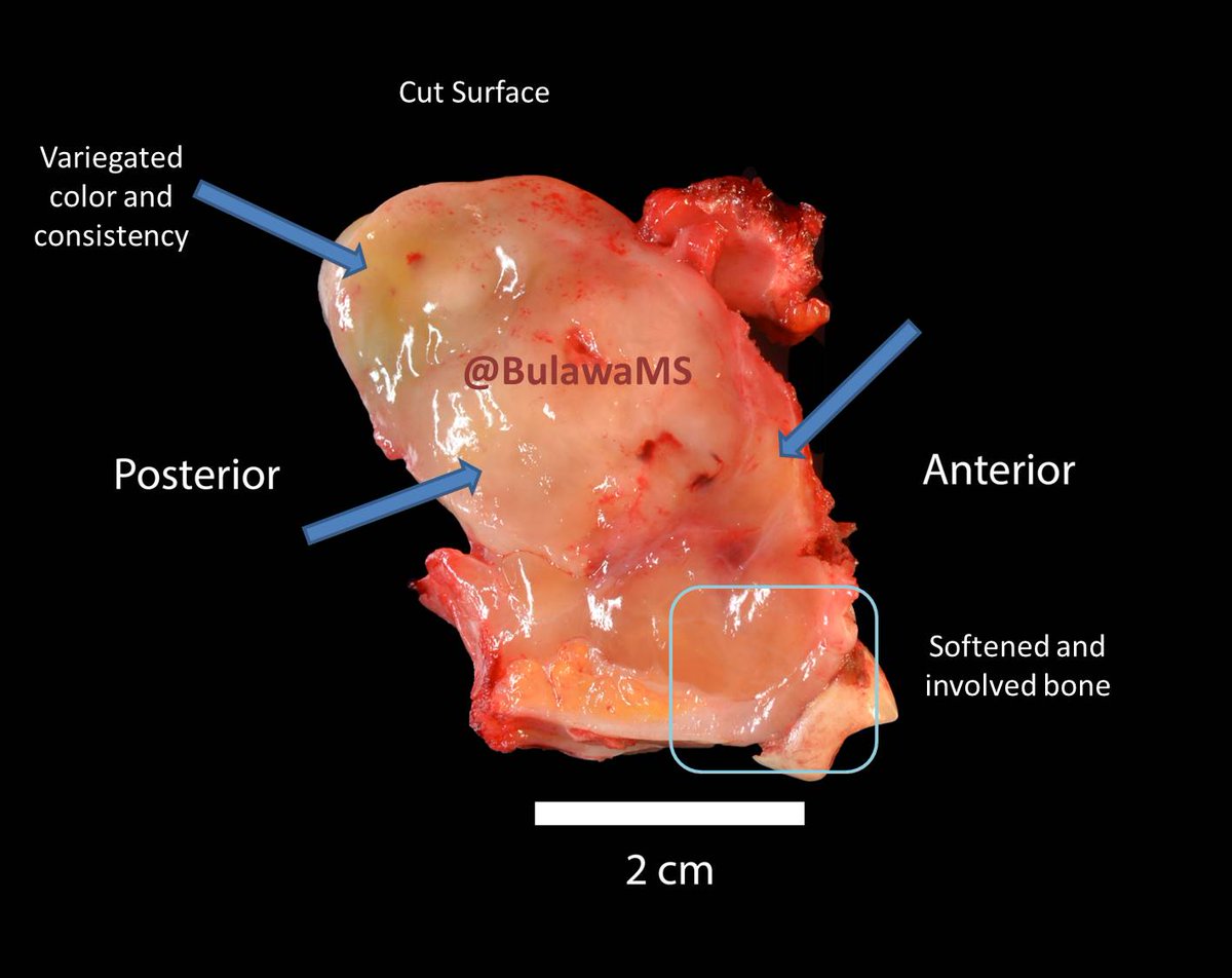 When grossing oral maxilla/mandible specimens, knowing the difference between soft tissue and mucosal margins is important. When in doubt, have the surgeon orient you. Also make sure to note bone involvement. Use teeth to help orient. #maxillectomy #pathology