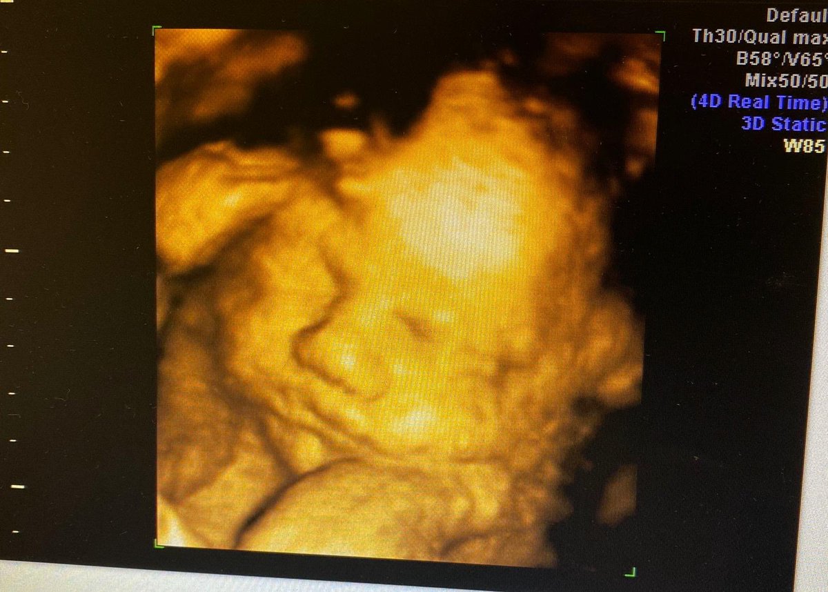 Hey Guys here is my latest You Tube video of our baby girl being a little bit camera shy at our 3D scan 👶🏻 🥰💕youtu.be/rqOLP06e2hE 
 #camerashy #cute