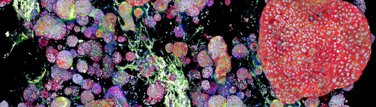 The research group of Jarno Drost has succeeded to culture mini-tumors in the lab from patient material. Read more: bit.ly/2W0YIJP #organoids #kidneytumors #research #innovation #pediatriconcology #princessmaximacenter