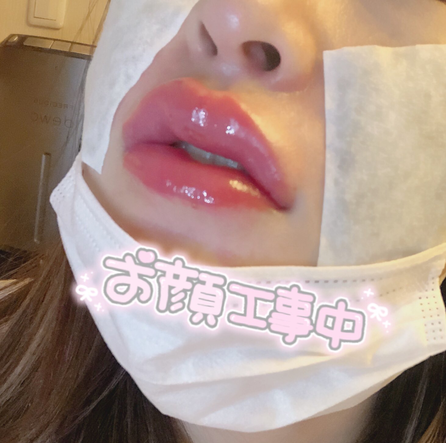 Ren Av女優 ほうれい線と唇にヒアルロン酸 頬と口角と顎にボトックス 注射痕あり過ぎやし 腫れ過ぎてめっちゃ痛い 笑 じんじんする感じの痛み いっつも先生に アンジー アンジェリーナ ジョリー にして ってお願いしてる 笑 笑 T Co Ren Av女優 ほうれい線と唇にヒアルロン酸 頬と口角と顎にボトックス 注射痕あり過ぎやし 腫れ過ぎてめっちゃ痛い 笑 じんじんする感じの痛み いっつも先生に アンジー アンジェリーナ ジョリー にして ってお願いしてる 笑 笑 T Co