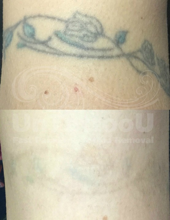 UntattooU's tweet photo. UnTattooU: PicoSure Laser Tattoo Removal
Before &amp; After

[Removal in just 4 treatments. Professional black and green tattoo located on clients upper arm. Age of tattoo: 21 years old.]

#lasertattooremoval #picosure #tattooregret #tattooremoval #tattoos https://t.co/z4edUrGOlN