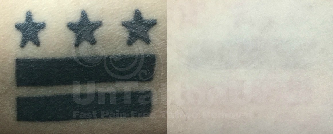 UntattooU's tweet photo. UnTattooU: PicoSure Laser Tattoo Removal
Before &amp; After

[Removal of an all black professional tattoo located on clients inner bicep]

#lasertattooremoval #picosure #tattooregret #tattooremoval #tattoos https://t.co/0WAEPhKgqN