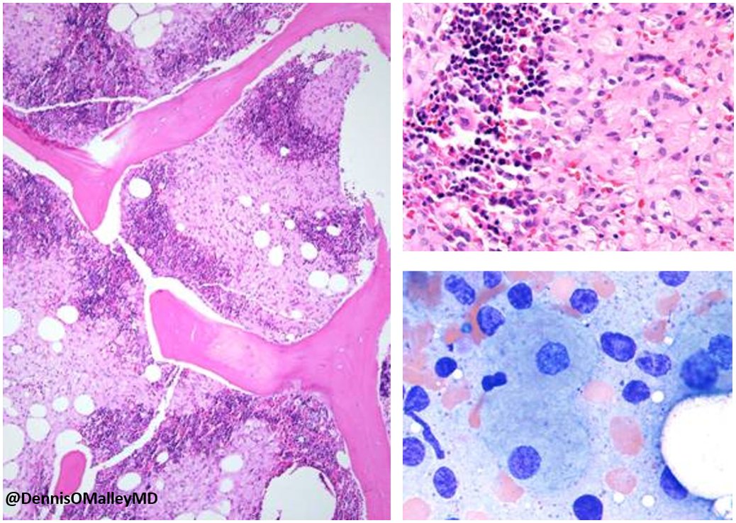 DennisOMalleyMD's tweet photo. Gaucher disease in bone marrow #Pathology #Gaucherdisease https://t.co/rlEgpL8Z5W