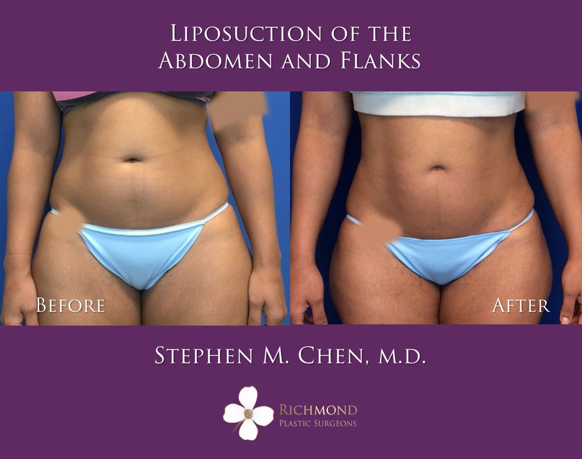 RPSRVA's tweet photo. Another happy #liposuction patient! Check out her before and after photos following liposuction of the abdomen and flanks by Dr. Chen. Post op photos were taken two months after surgery. 

📞804.285.4115
https://t.co/xngvA0LkPx
https://t.co/7SAwTBQ9Zx https://t.co/emjTO7fPSm