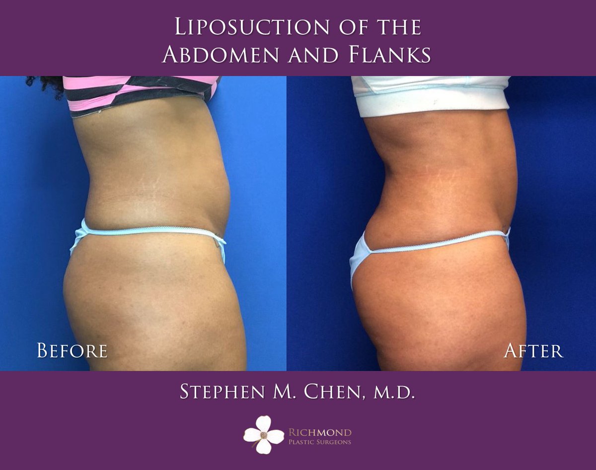 RPSRVA's tweet photo. Another happy #liposuction patient! Check out her before and after photos following liposuction of the abdomen and flanks by Dr. Chen. Post op photos were taken two months after surgery. 

📞804.285.4115
https://t.co/xngvA0LkPx
https://t.co/7SAwTBQ9Zx https://t.co/emjTO7fPSm