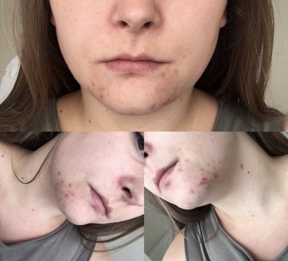 mayfairpractice's tweet photo. SEE THIS SKIN TRANSFORMATION! ⬇️⬇️⬇️

Working with us, Hayley was given a skincare routine to follow AT HOME, partnered with regular #HydraFacial treatments 🤩

If you’re struggling with your skin, we think these results speak for themselves 💕

https://t.co/fH60MPJfue https://t.co/NYbzFWbB2N