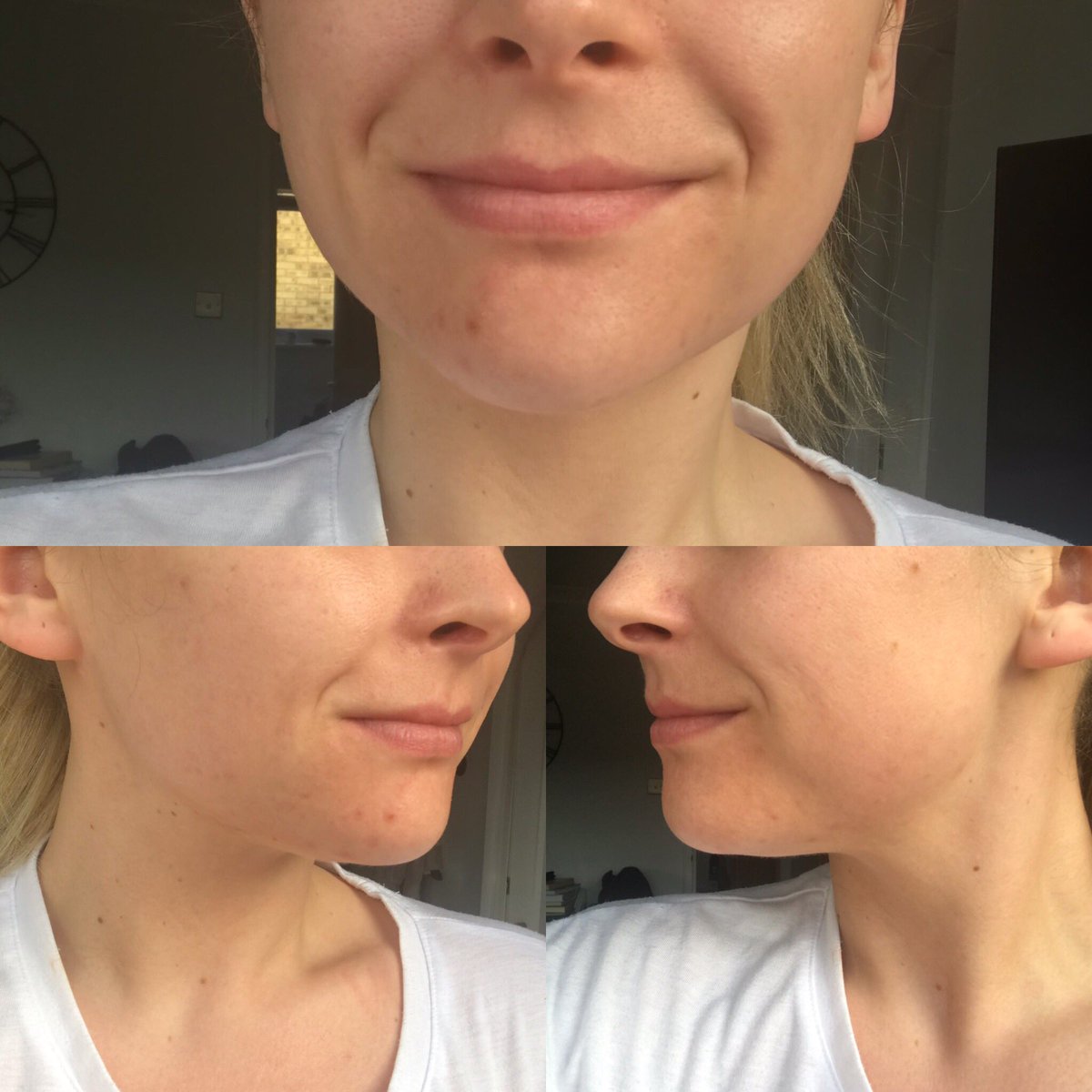 mayfairpractice's tweet photo. SEE THIS SKIN TRANSFORMATION! ⬇️⬇️⬇️

Working with us, Hayley was given a skincare routine to follow AT HOME, partnered with regular #HydraFacial treatments 🤩

If you’re struggling with your skin, we think these results speak for themselves 💕

https://t.co/fH60MPJfue https://t.co/NYbzFWbB2N