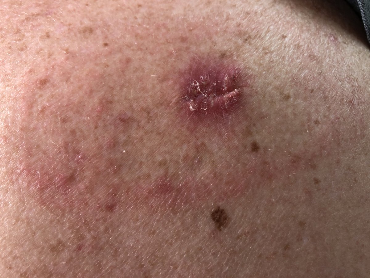 To the young farmers. This is my shoulder after having my first melanoma removed. I was always too busy for sun screen or long shirts... it won’t happen to me! I’m 51 yrs old. Protect your skin. This cancer can be avoided.