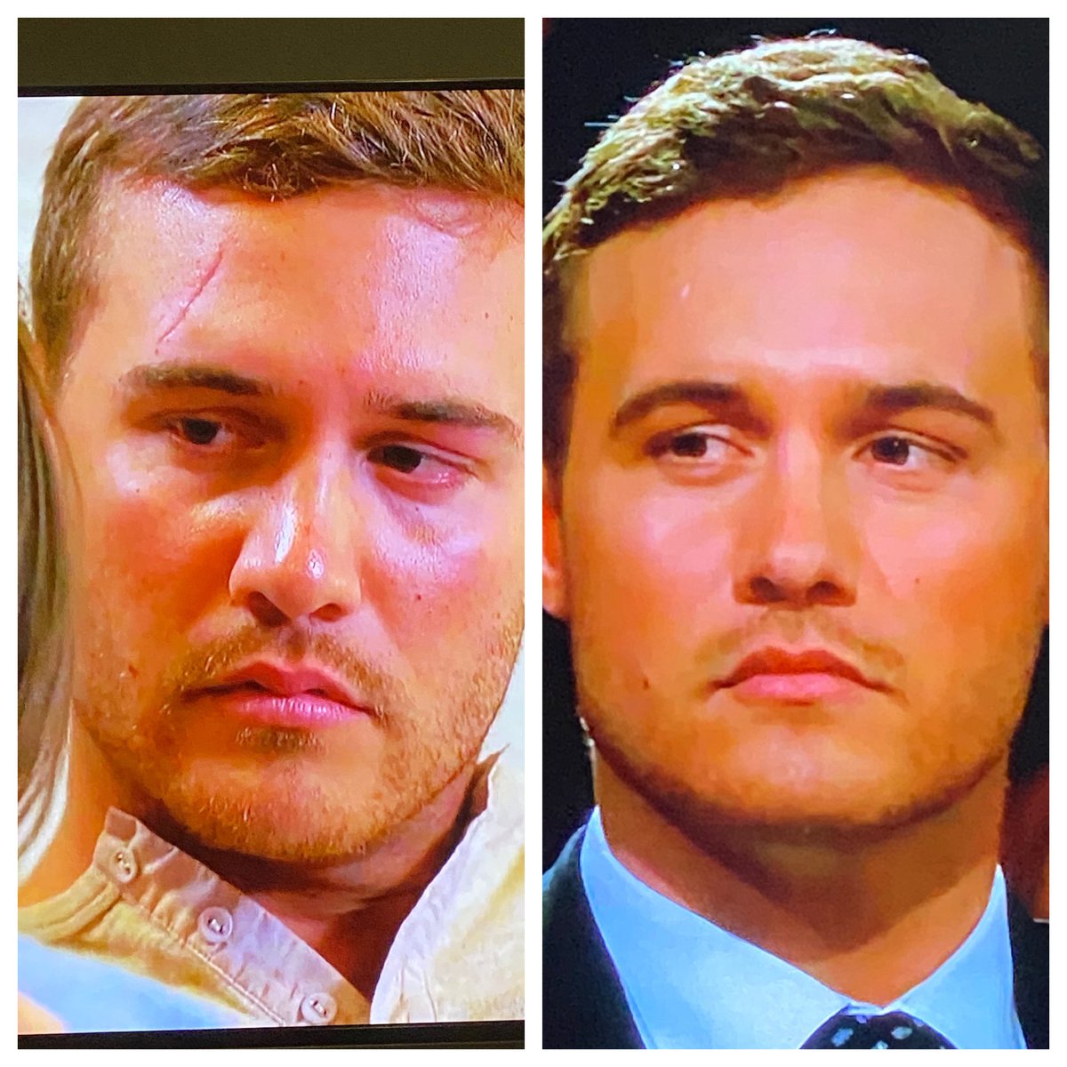 MomProblems5's tweet photo. During his season vs after: Peter’s scar is definitely symbolic of his inner pain #TheBachelor #bachelorpeter https://t.co/HPMUvWOG9t