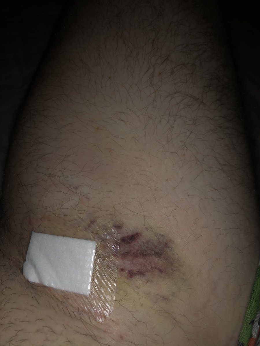Jakeclews1's tweet photo. Why’s my leg look like a zombie bite are you madddddddd that zombies childish https://t.co/I4TFz3G27L