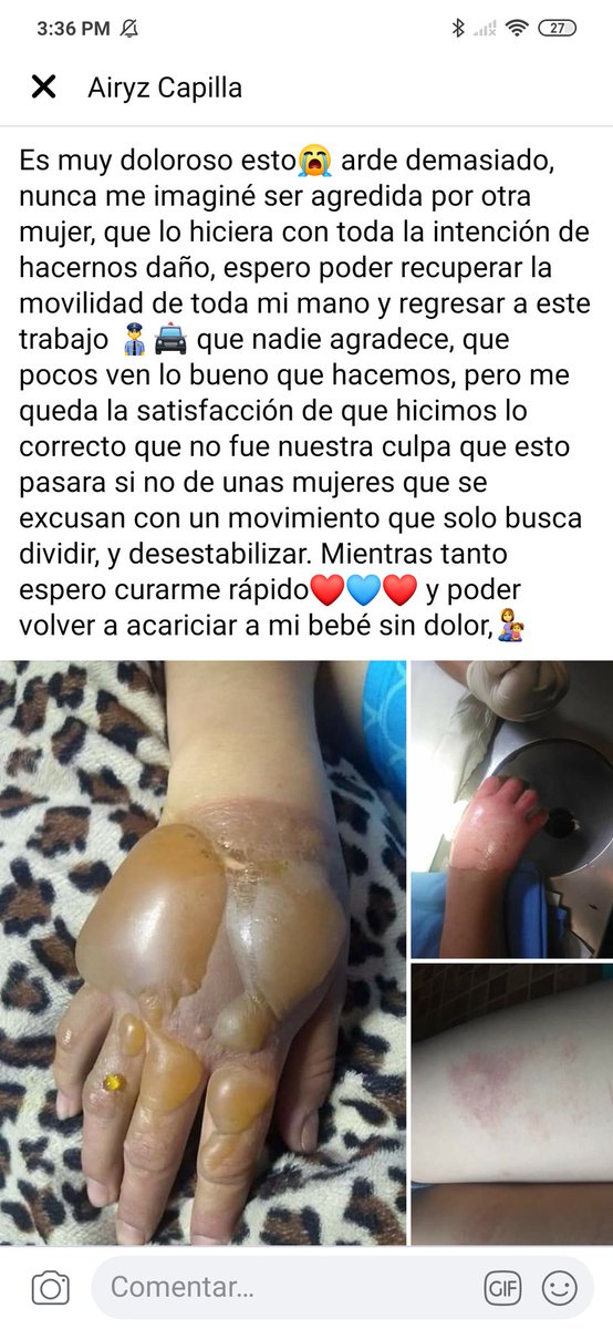 rochaferluis's tweet photo. Mi sobrina y fue una de las policías que salió herida en la marcha del domingo resguardando la puerta de palacio nacional.
Ahora el problema es que esta en una clínica y ni siquiera pudo dormir en una cama @jrisco @lopezdoriga @CarlosLoret @c4jimenez @Adela_Micha @warkentin https://t.co/xbLLsHSnJs