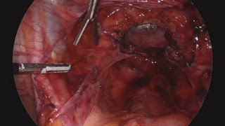 AAGL's tweet photo. Pelvic #lymphadenectomy requires understanding of retroperitoneal #anatomy and meticulous dissection. This #SurgeryU #SurgeryNew video highlights the technique necessary to complete this procedure #laparoscopically.
https://t.co/TpGadseQU1 https://t.co/Ibas2Mv2us