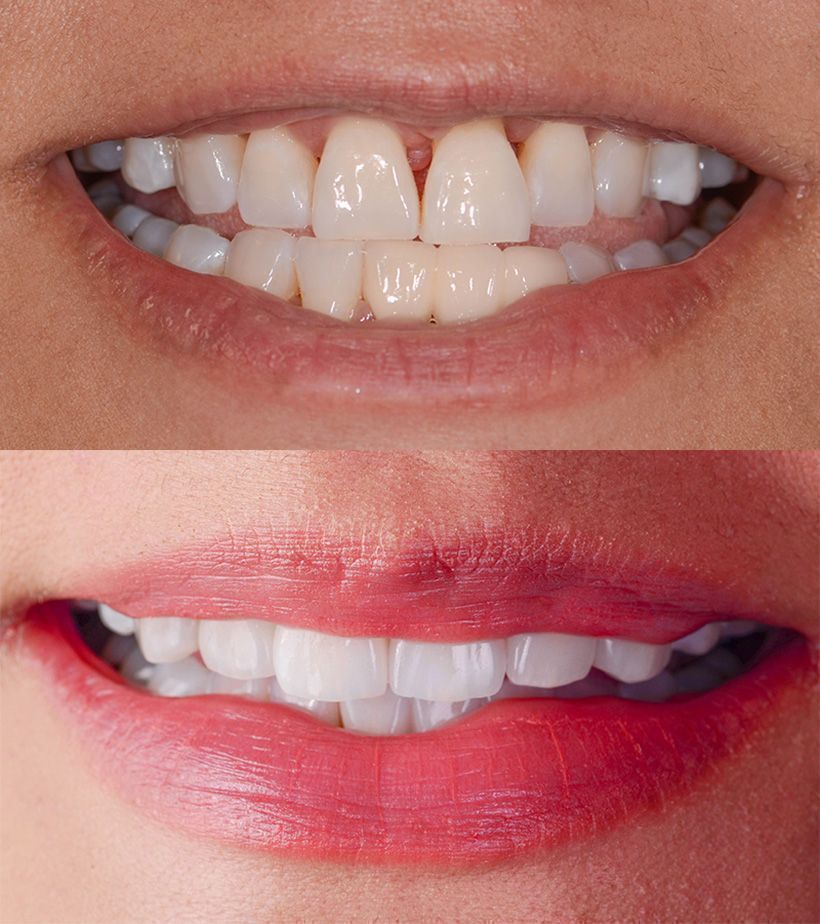 ArtLabDentistry's tweet photo. This is another beautiful ArtLab Dentistry restoration using a combination of veneers, crowns, implant crown, and a bridge. https://t.co/ug15tWTzrG #dentalimplants #dentistry #porcelainveneers https://t.co/0ynrlCRnGH