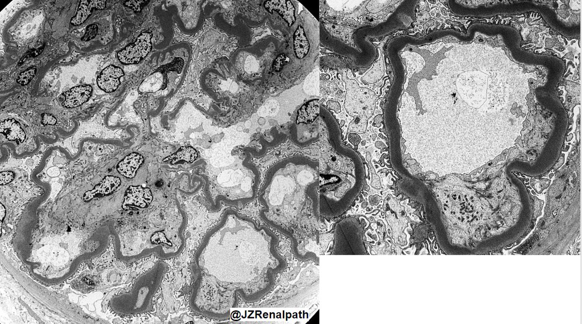 JZRenalPath's tweet photo. Interesting case of dense deposit disease following eculuzimab treatment. F/u bx with C3 deposits and IgG-kappa deposits in some gloms and TBMs c/w eculuzimab deposition. #renalpath   https://t.co/GKlESh2sHX https://t.co/TGTgQ0RQKc