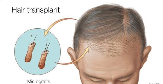 LooksClinic's tweet photo. #Micrograft #FUE #Hair #Transplant @39,990 by Qualified #Team of #Doctor @LooksClinic, Free #Consultation on WhatsApp @+918828126315 https://t.co/sg7DfPO1eX