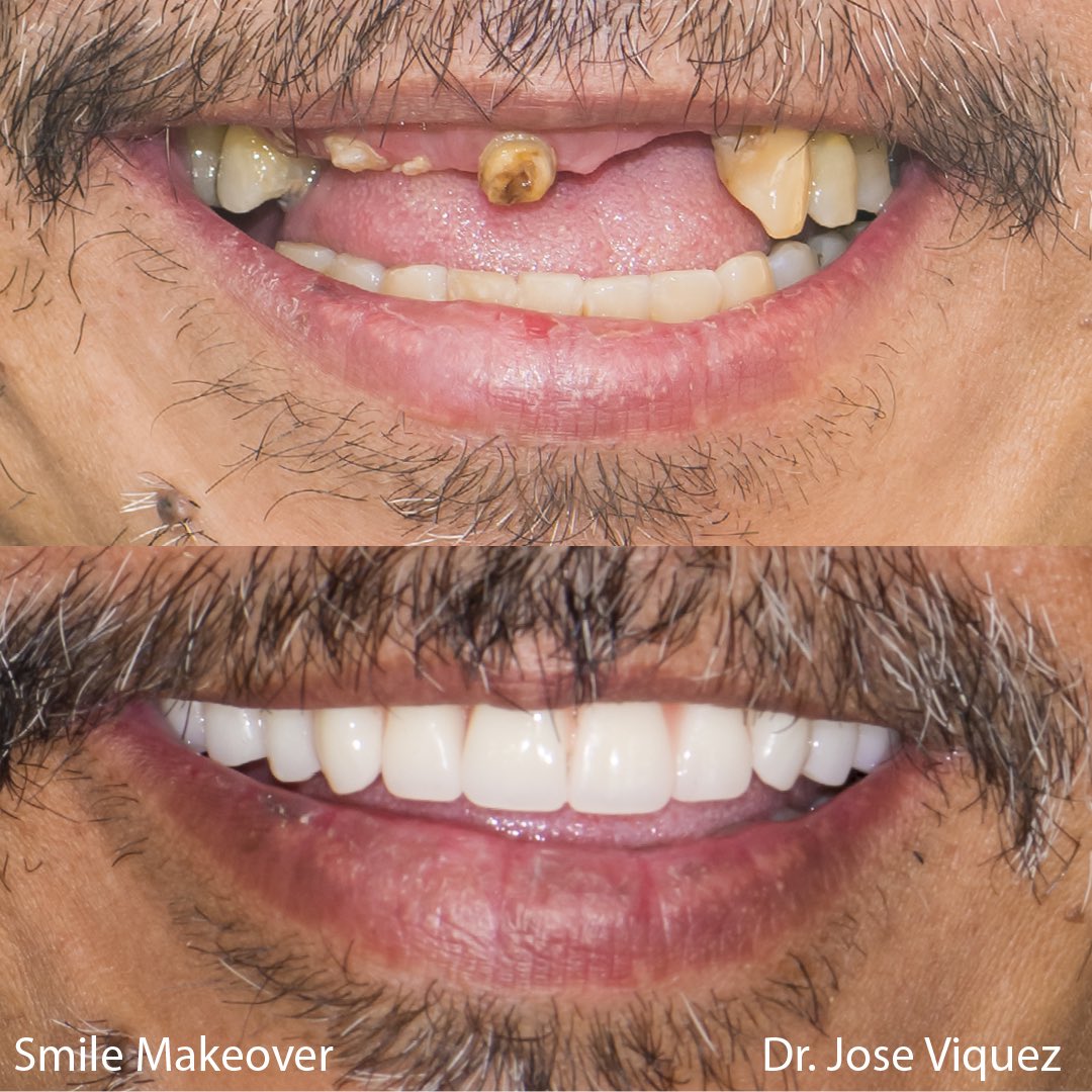 SSGDental's tweet photo. Here’s another great result from our talented prosthodontist, Dr. Viquez!

Visit https://t.co/QpuJNZdi9n or call 204.488.0550 to learn more about #Winnipeg’s largest and most comprehensive multi-specialty dental clinic and book your referral or consult today!

#winnipeg #wpg #mb https://t.co/xcitK8jG9v