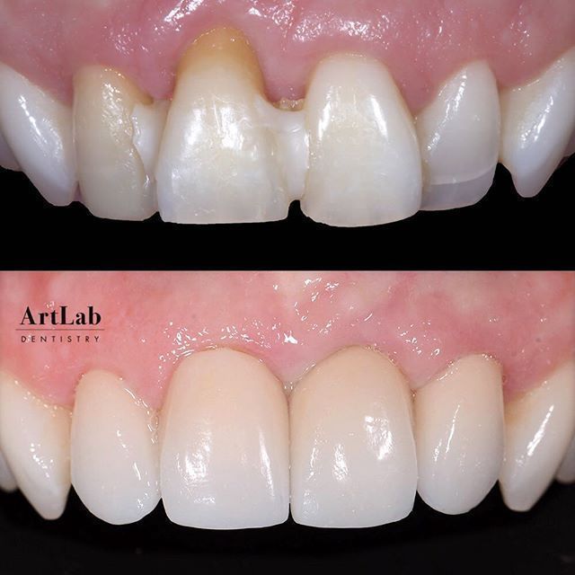 ArtLabDentistry's tweet photo. We used crowns and an implant to restore these teeth to beauty after they were damaged in an accident.https://t.co/ug15tWBYA8 #smilemore #restoration #prosthodontist #brentwood https://t.co/zG7Xu39QFt