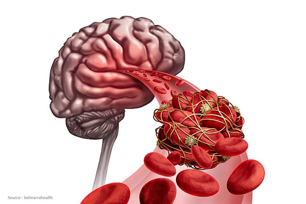 Healthnews24x7's tweet image. Blood clot in brain #braincloth #brainproblem healthnews24seven.com/brain-blood-cl…