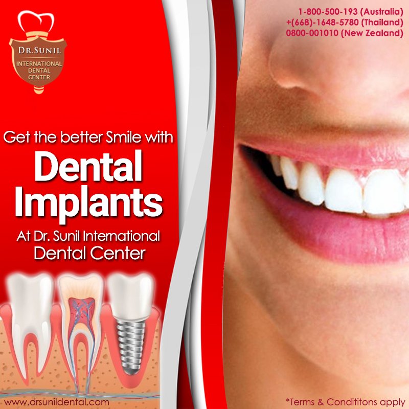 drsunilphol's tweet photo. #DentalImplantsBangkok at #DrSunilDentalClinic https://t.co/l8opS7uRdR