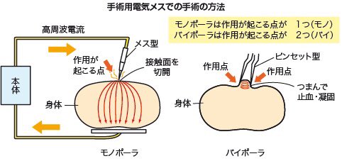 Sho バイエルンで人工関節 Na Twitteru 豆知識 関節鏡で使う熱凝固機器 電気メス的な はモノポーラではなくバイポーラだけどこれはモノポーラだと還流液 リンゲル液 で通電してしまうから 当施設はブドウ糖液で還流してモノポーラを使ってます Sho バイエルンで人工関節 Na Twitteru 豆知識 関節鏡で使う熱凝固機器 電気メス的な はモノポーラではなくバイポーラだけどこれはモノポーラだと還流液 リンゲル液 で通電してしまうから 当施設はブドウ糖液で還流してモノポーラを使ってます