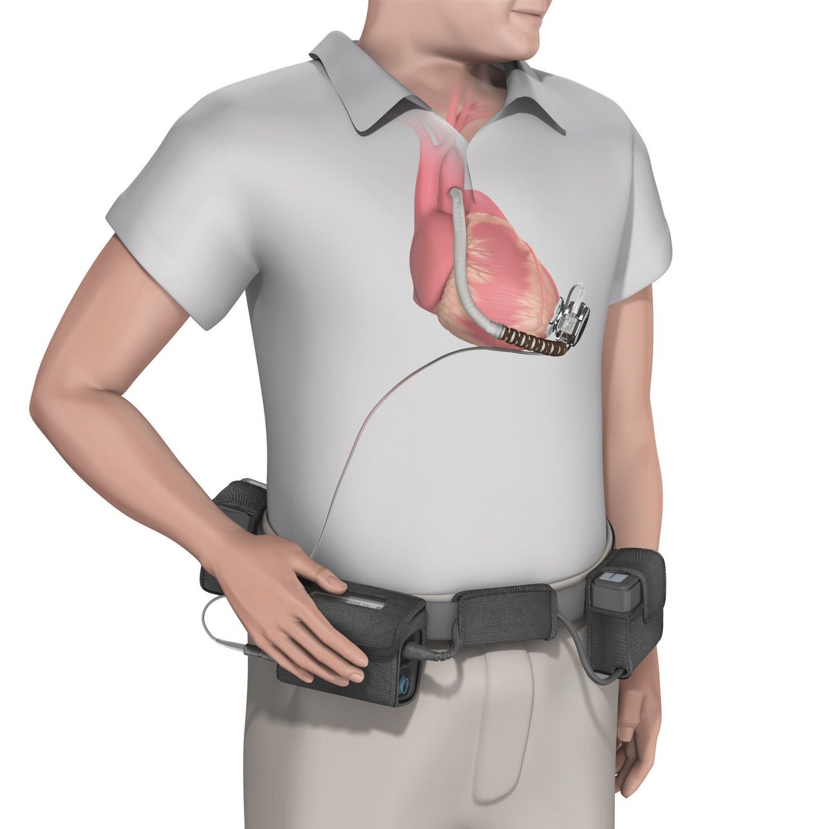 MercElectromed's tweet photo. #SabiasQue 
el sistema HVAD de #Heartware, #VAD de elección para la mayoría de los programas de #fallocardiaco, presenta los mejores datos de supervivencia a 2 años con la menor tasa de #ictus deshabilitantes?
Est."LATERAL"https://t.co/1Z2B4OKfXa 
#HeartFailure #medtronic hilo👇 https://t.co/ipM0T0ULd7