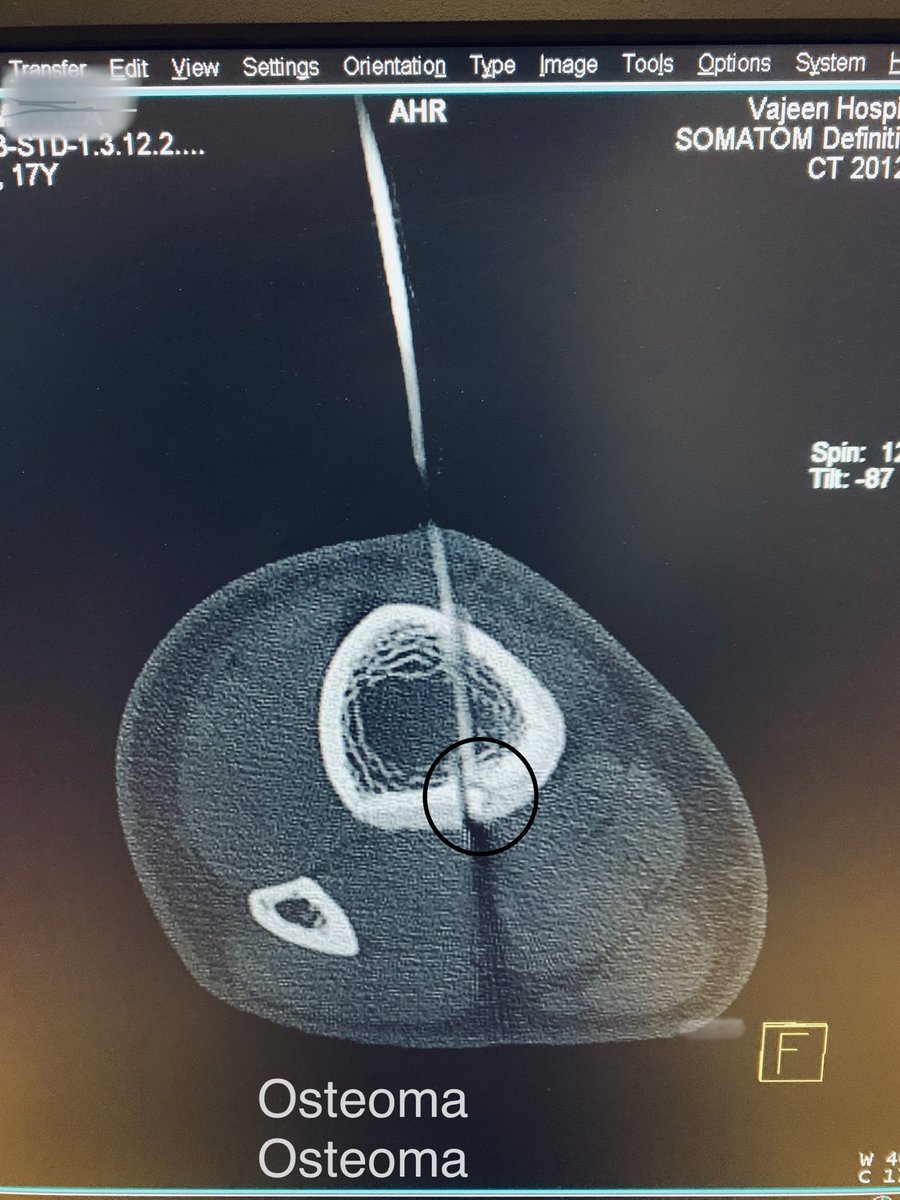 SUHAIBa2t's tweet photo. Radiofrequency Ablation RFA of Osteoid Osteoma (tibia)
#interventionalradiology  #pairs2020
#withoutascalpel https://t.co/bVgbPrHo9g