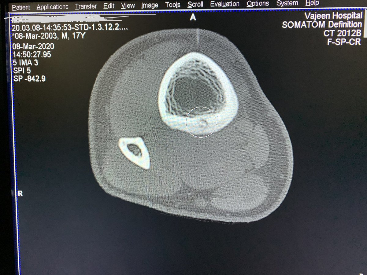 SUHAIBa2t's tweet photo. Radiofrequency Ablation RFA of Osteoid Osteoma (tibia)
#interventionalradiology  #pairs2020
#withoutascalpel https://t.co/bVgbPrHo9g