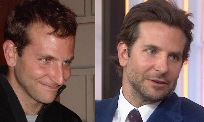 ScalpProvoco's tweet photo. Did #BradleyCooper have #SMP? His hair is look so much thicker &amp; fuller than it once was and we love it! #hairlossformen #thickhair #thinninghair #balding #celebshair https://t.co/W8c4qALA5h