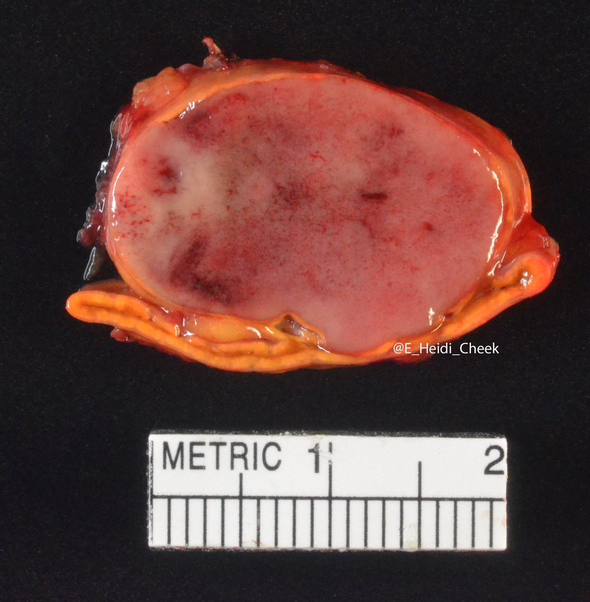 E. Heidi Cheek, MHS, PA(ASCP) tweet media