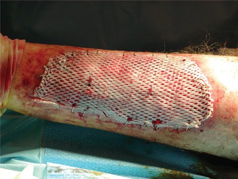 Research shows that a skin-graft harvesting system aids chronic wound recovery and reduces care costs by accelerating the healing process. ht.ly/aOUK30qpfP0 
#woundcare #woundhealing #burns #HCM