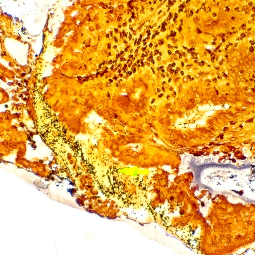 ac_pathgal's tweet image. H. pylori on Warthin-Starry stain! 
#notsosubtle #gipath #pathboards #pathtwitter