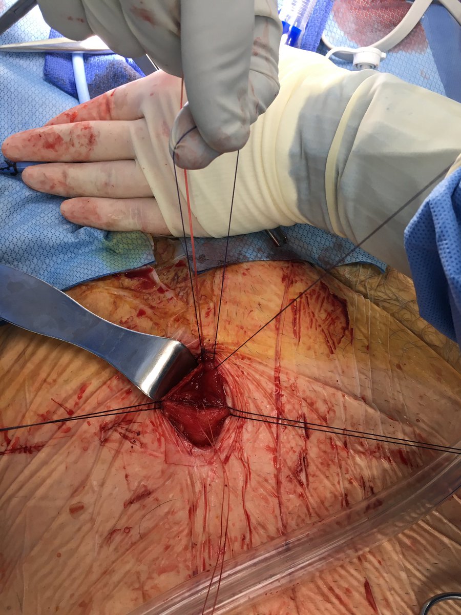Pioneered at <a href="/CleClinicUro/">Cleveland Clinic Urology</a> : Docking the single port robot directly into the bladder to do a #prostatectomy. No need to bivalve the bladder, minimal blood loss, remove bladder stones if needed, early foley removal. All thru a small suprapubic incision. See publication link below.