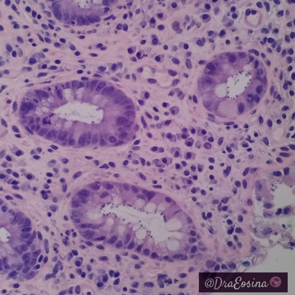 #YomequedoenCasa no es una opción para mí. Sigue habiendo pacientes que necesitan nuestros diagnósticos, como esta niña con leucemia y una infección por Criptosporidium.
Por favor, pon de tu parte: quédate en casa, lávate las manos. GRACIAS
#Covid_19