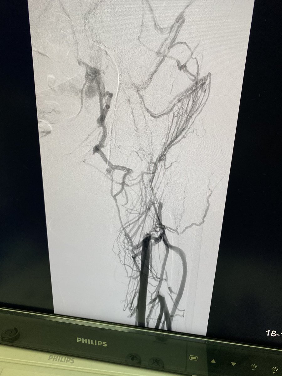 ElwerEng's tweet photo. First case in Security force /Riyadh done by doctor Abdulmajeed Alhazzani using Cat8Xtorq with Indigo from Penumbra 
Right Femoral iliac IVC  DVT case for 28 years old female patient with subacute thrombus (15 days) https://t.co/DDvr1Qeui3