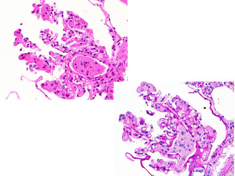 MPAlexanderMD's tweet photo. Proximal tubule squished into the glomerular capillaries. Not fibrin thrombi or platelet thrombi. #firsttimeforme @GlassockJ @vighnesh_w @ClarissaCassol @sam_albadri @JZRenalPath @ChangUCanSpare @HerrmannMd https://t.co/XKDylQIznH