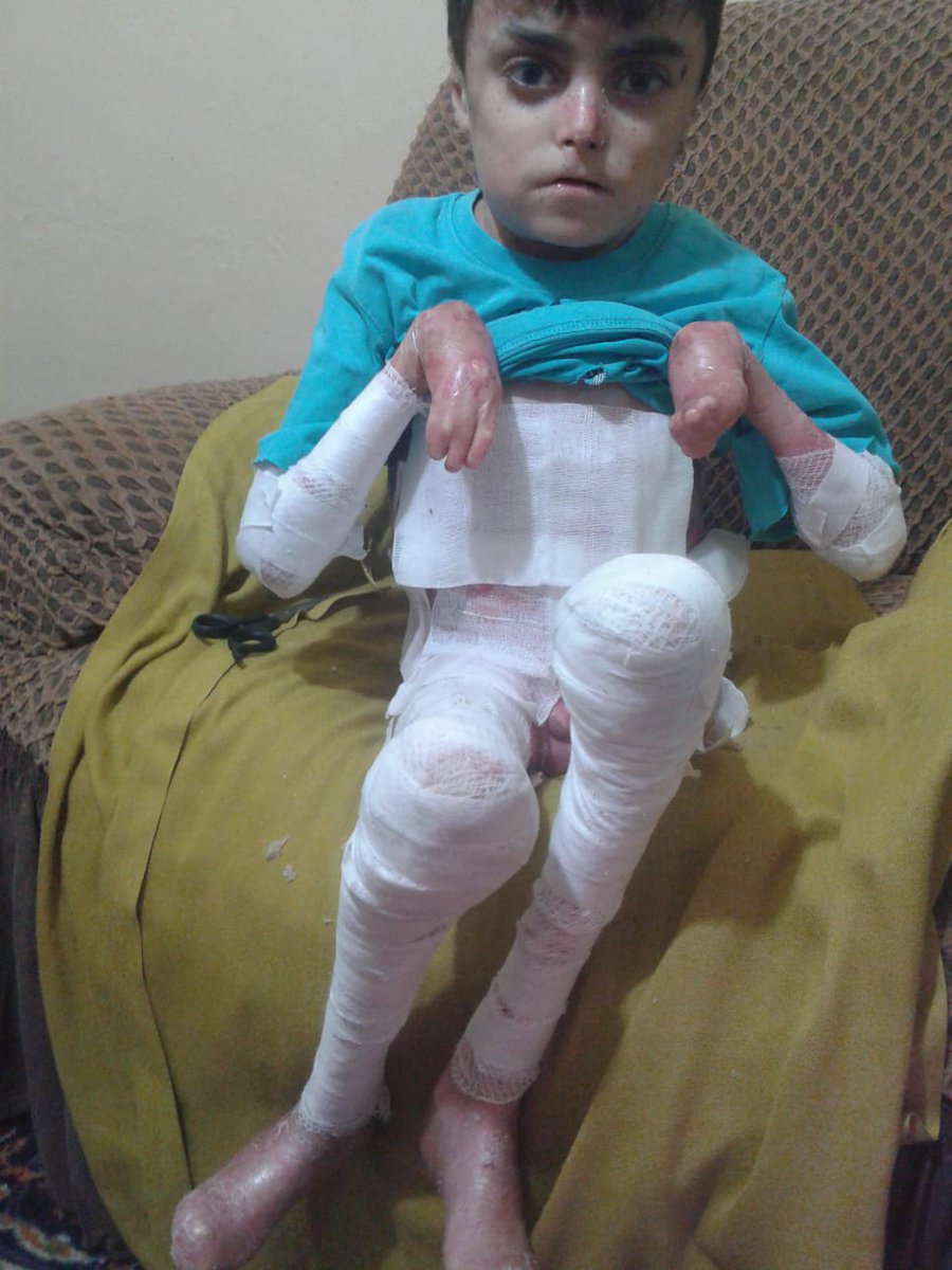 QUSAY_NOOR_'s tweet photo. My son Ahmed is 15 years old. He suffers from pemphigoid, and he needs special care and special foods. He and his mother entered the crossing into Turkey.  After a while, I went into Turkey illegally with our two other children, because his mother can not take care of Ahmed alone https://t.co/6j02RGrry7