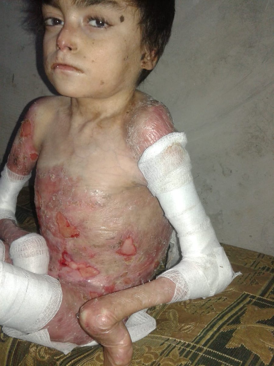 QUSAY_NOOR_'s tweet photo. My son Ahmed is 15 years old. He suffers from pemphigoid, and he needs special care and special foods. He and his mother entered the crossing into Turkey.  After a while, I went into Turkey illegally with our two other children, because his mother can not take care of Ahmed alone https://t.co/6j02RGrry7