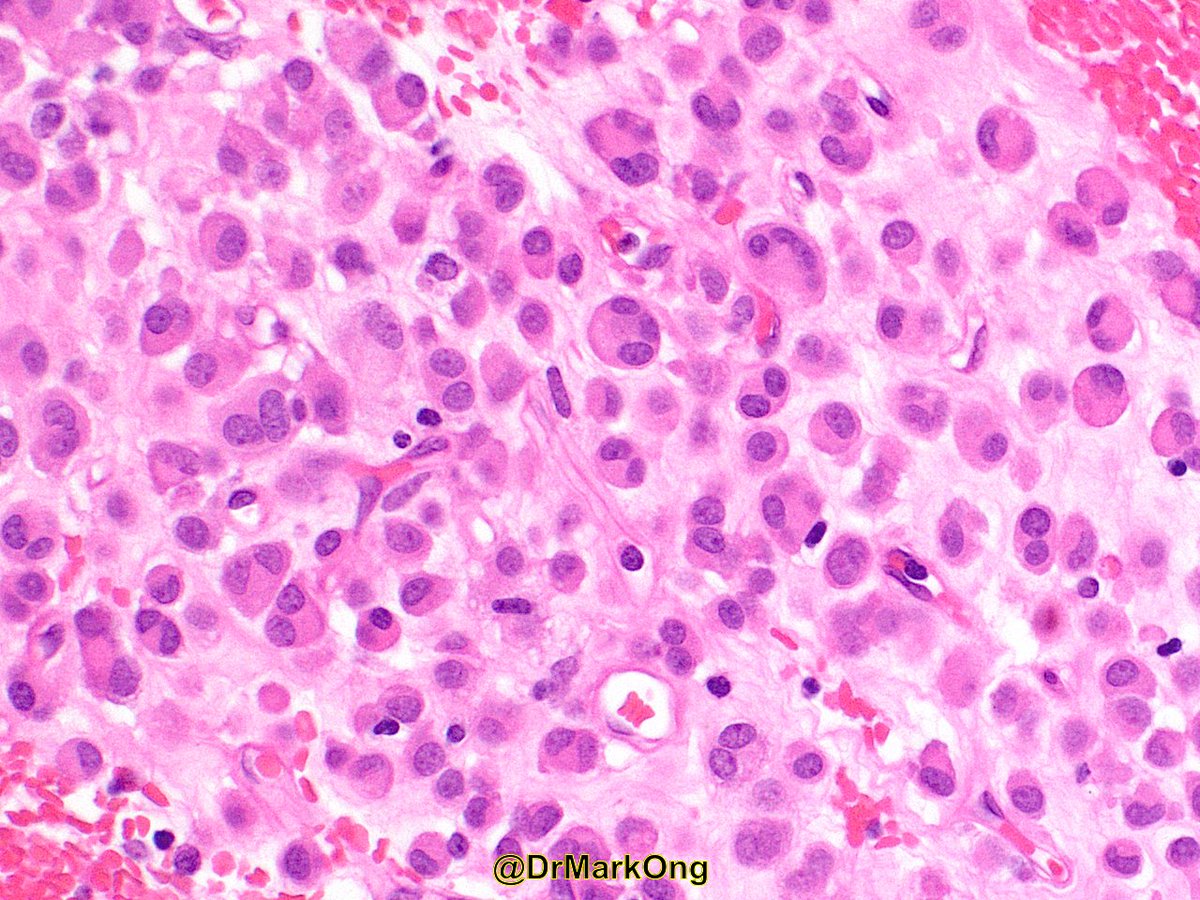 DrMarkOng's tweet photo. Here's the usual #tooclosetodiagnose challenge. What's the organ and what's the diagnosis? #pathology https://t.co/txdZjcnlO3